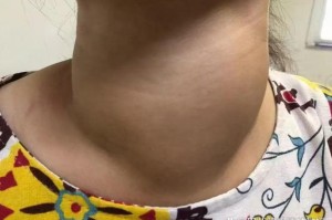 1.症状描述，颈部迅速肿胀如鹅蛋，急性颈部肿胀如鹅蛋