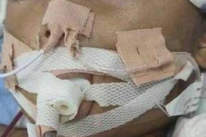 事件回顾，男童术后脑死亡引社会关注，男童术后脑死亡事件引社会广泛关注