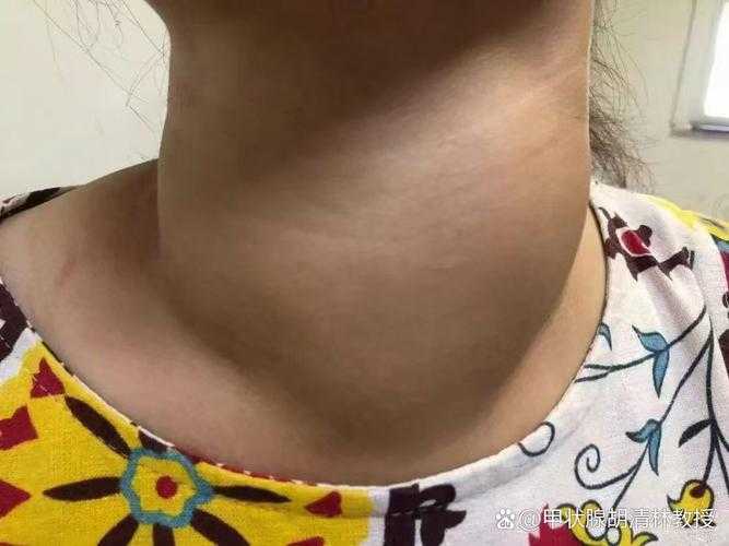 1.症状描述，颈部迅速肿胀如鹅蛋